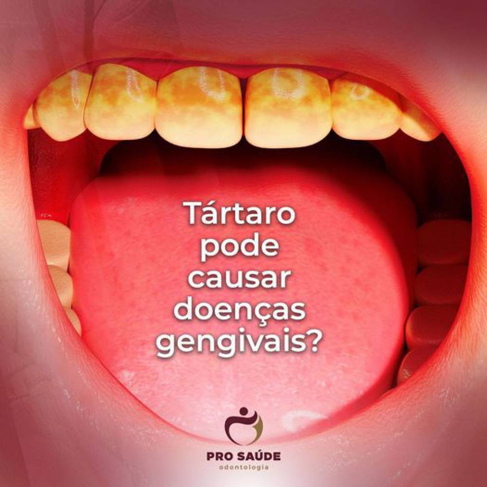 Tártaro pode causar doenças gengivais?